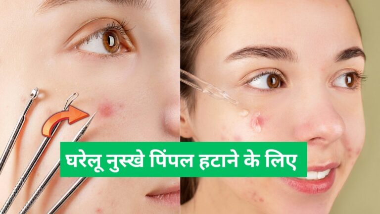 Pimple Kaise Hataye Gharelu Nuskhe